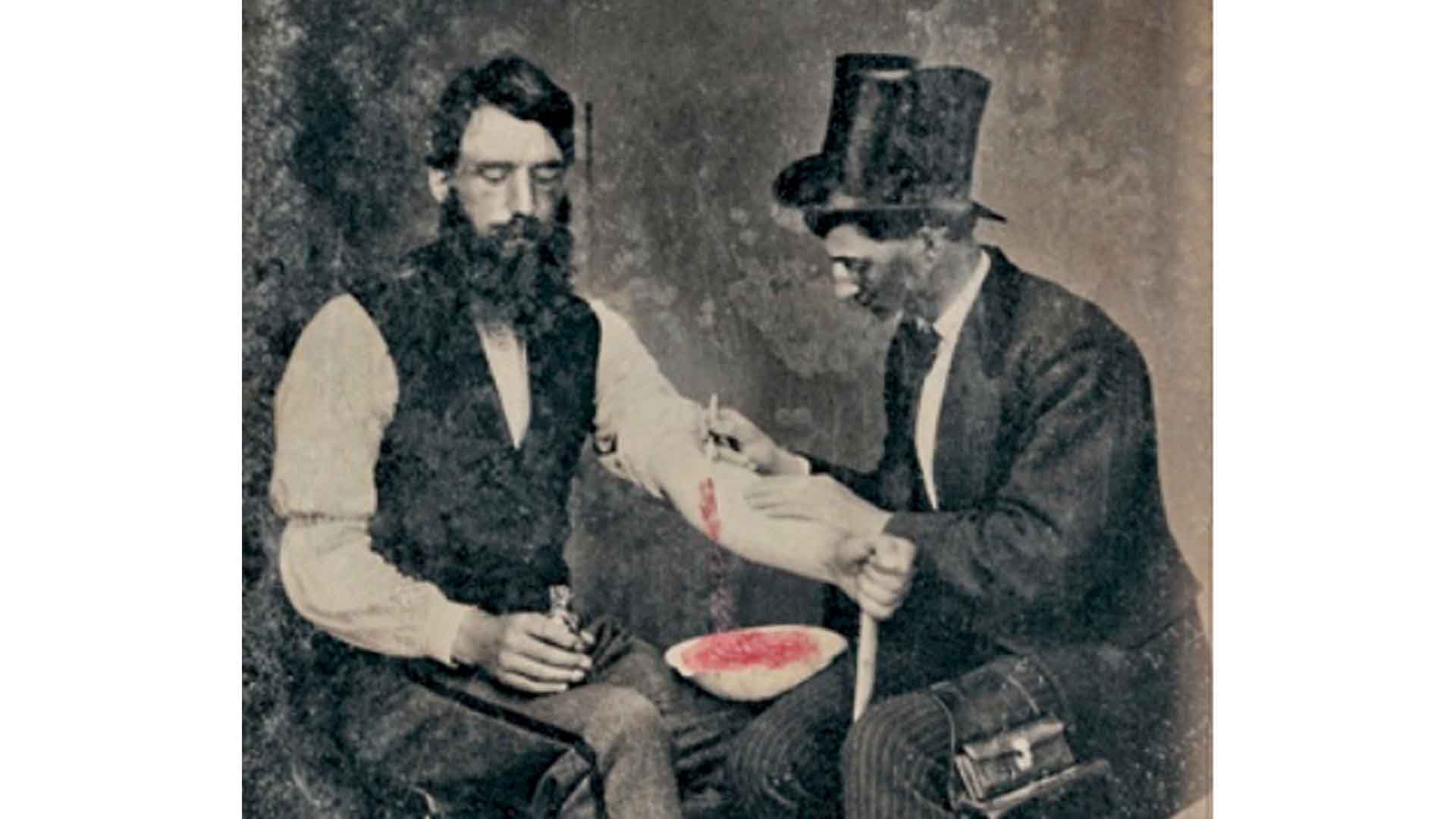Bloodletting, one of only three known photographs (tintype) of the procedure.