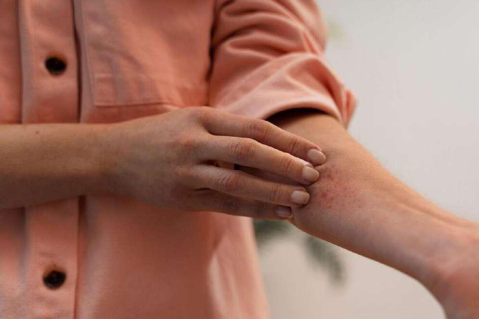 Woman itching a red and inflamed rash on her arm