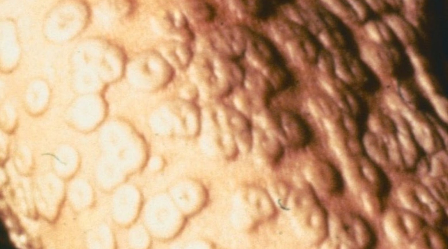 A close-up image of smallpox on a human body. The smallpox pores are skin-colored and round, and the body is covered in them.