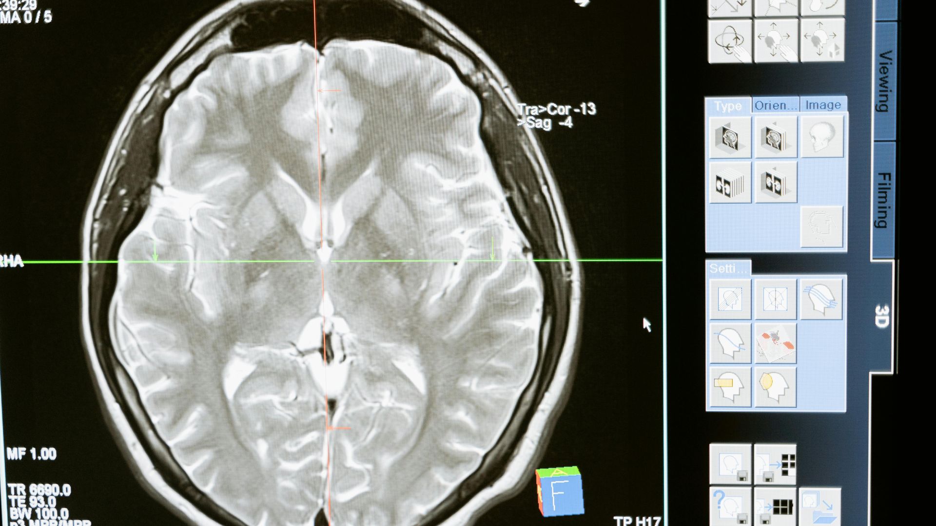 A close-up of a computer screen analyzing a brain scan.