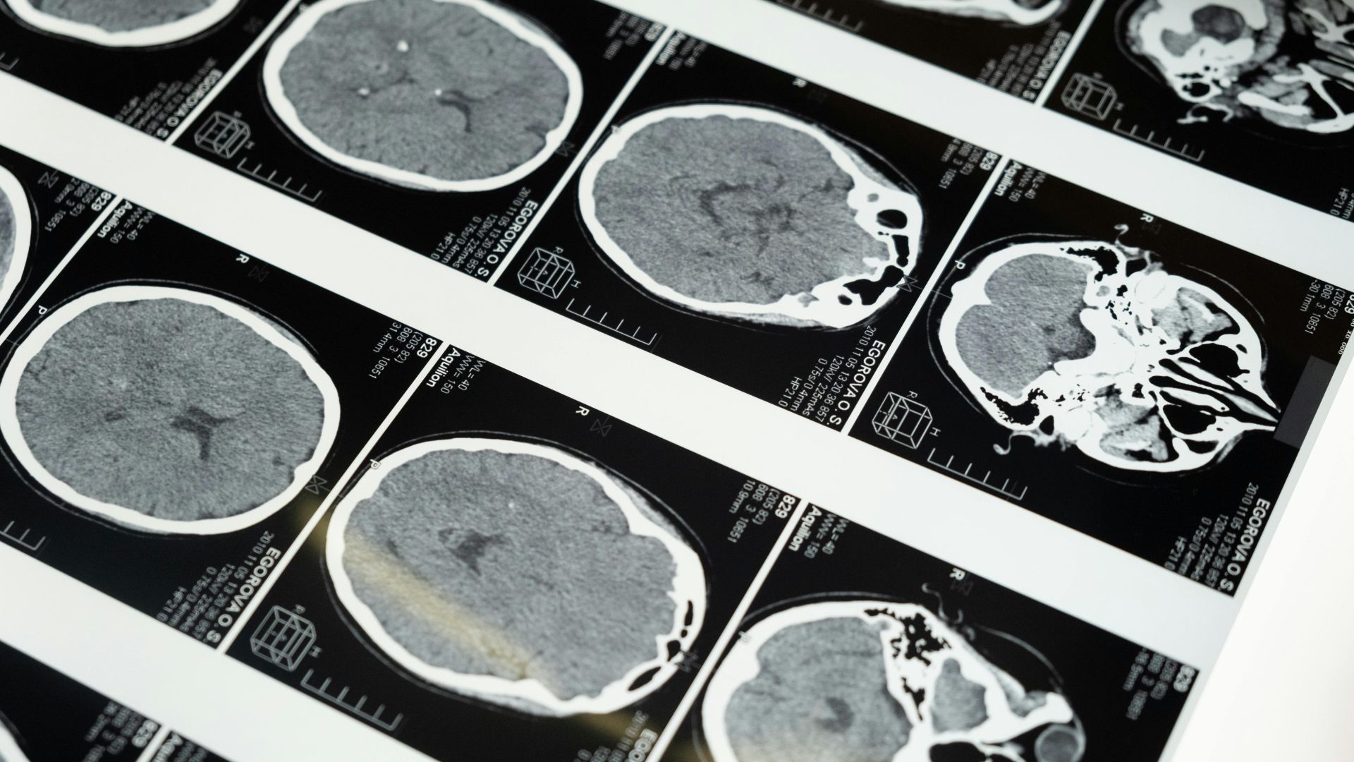 Many black and white images of the brain.