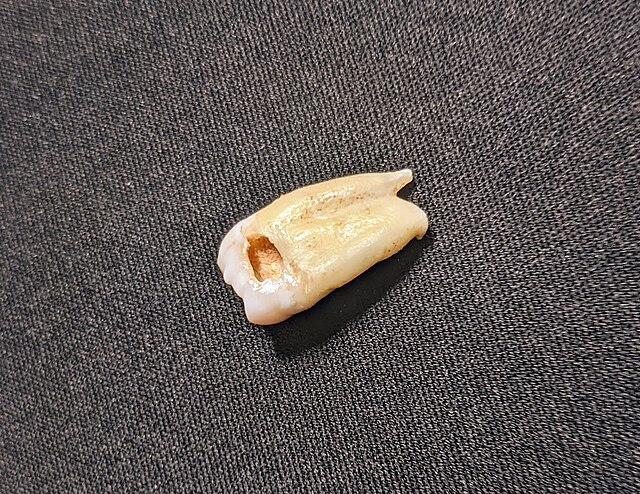 Wisdom tooth