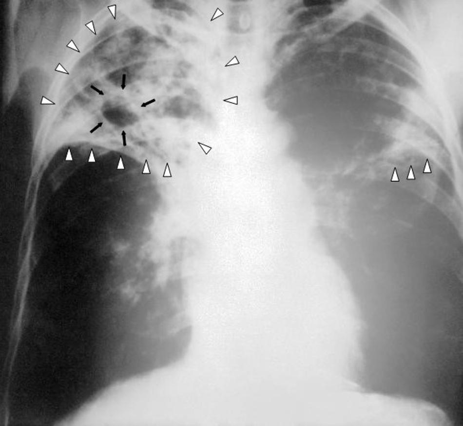 A photograph of a patient who’s been diagnosed with tuberculosis