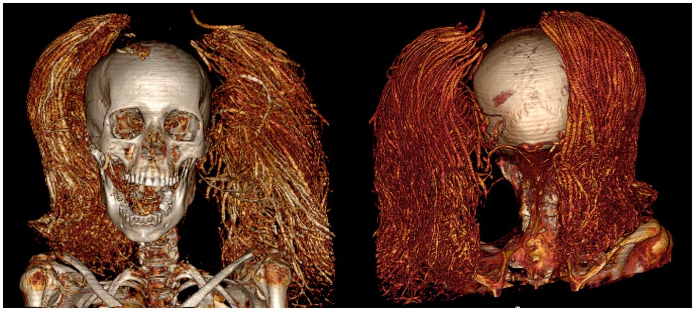 CT scan of the screaming mummy